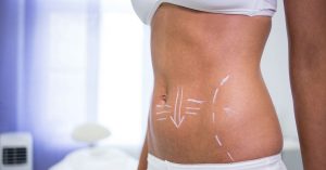 lipolaser-papada