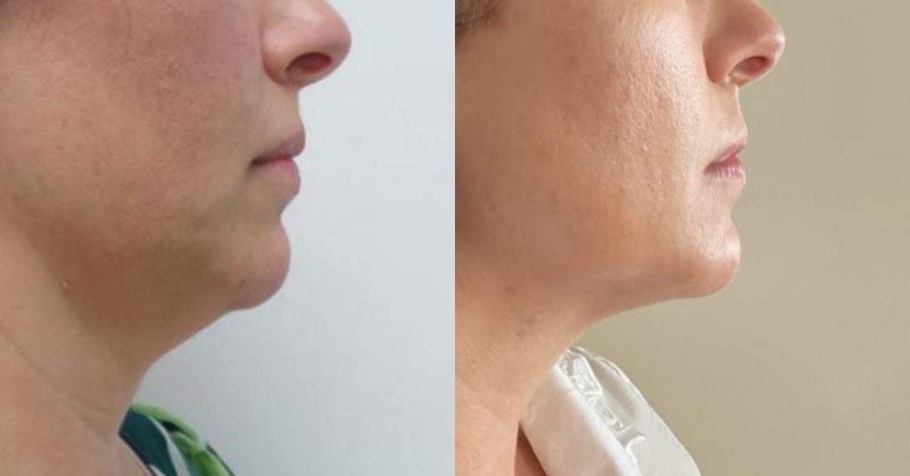 lipolaser-papada