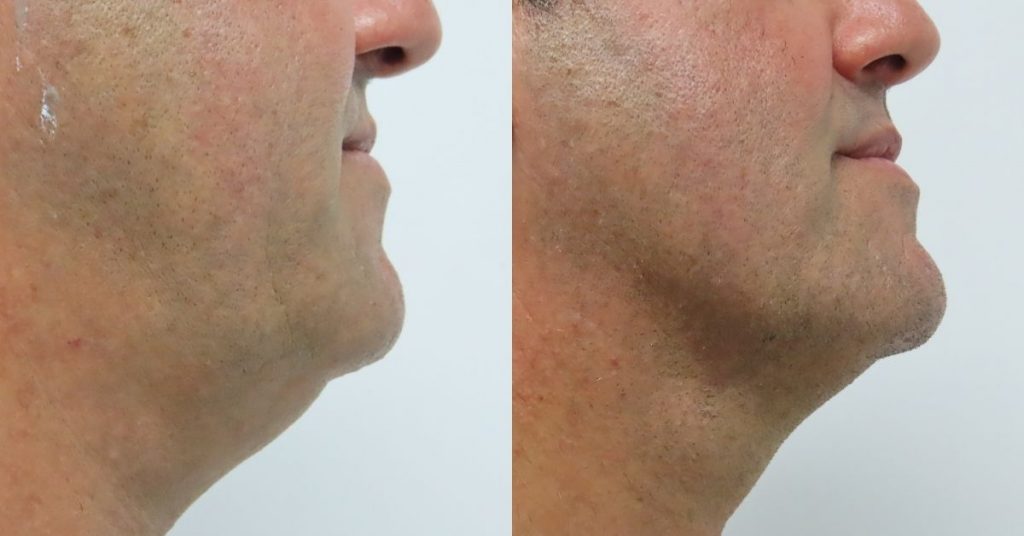 lipolaser-papada
